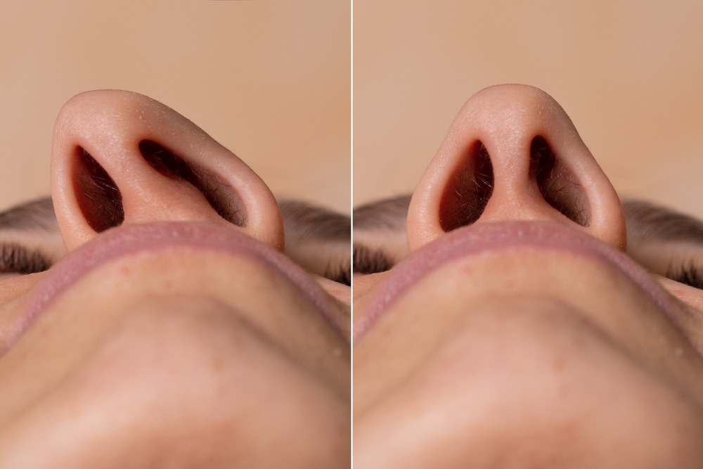Desviación del tabique nasal