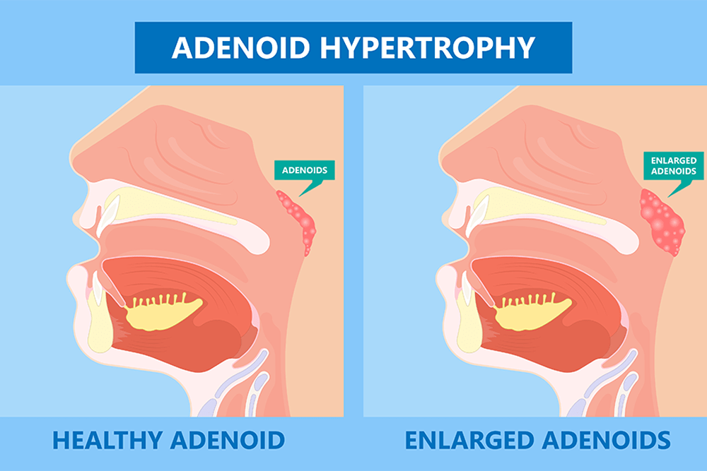 Hipertrofia de adenoides